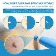 Skin Tag Remover - HOW DO I BUY THIS